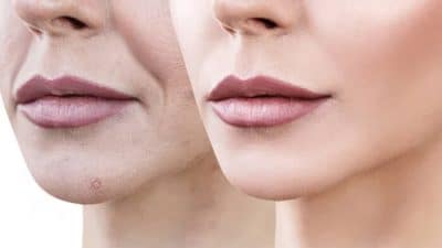Before and after results highlighting natural remedies in How To Tighten Face Skin Naturally At Home for firmer, youthful skin.