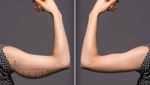 Before and after image of arm demonstrating how to tighten skin after weight loss naturally with improved skin tightness.