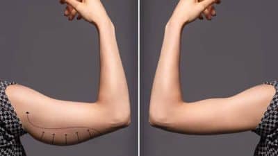 Before and after image of arm demonstrating how to tighten skin after weight loss naturally with improved skin tightness.