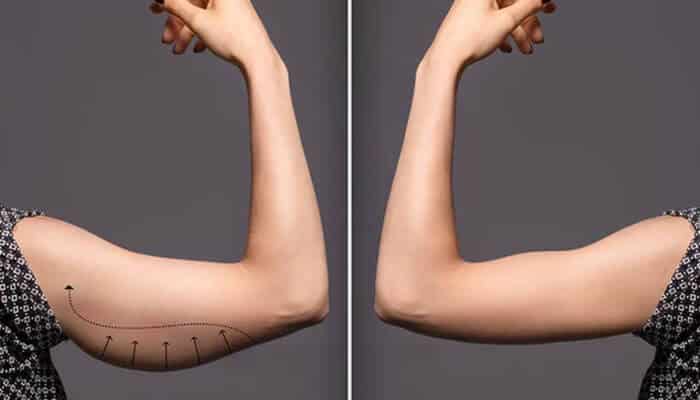 Before and after image of arm demonstrating how to tighten skin after weight loss naturally with improved skin tightness.