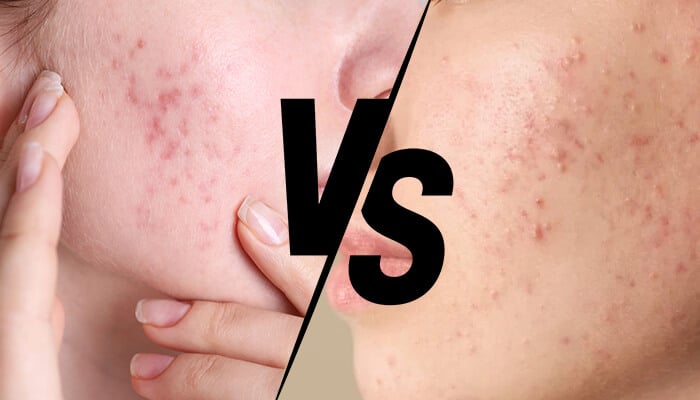 Comparison of fungal acne vs closed comedones on the skin, showing different stages of acne breakouts.