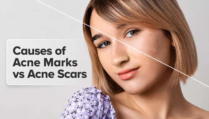 Causes of Acne Marks vs Acne Scars - Fashion In Beauty - Fashion in Beauty Acne Marks vs Acne Scars causes explained with facial skin showing post-acne discoloration, inflammation, and texture differences for skincare awareness.