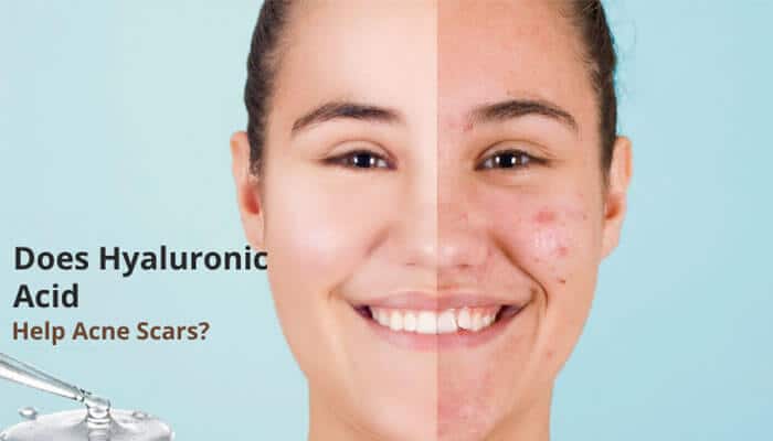 Does Hyaluronic Acid Help Acne Scars - Fashion In Beauty - Fashion in Beauty Does Hyaluronic Acid Help Acne? Realistic before-and-after style image showing acne scars, redness, and smoother hydrated skin, highlighting how hyaluronic acid supports skin barrier repair, moisture retention, inflammation reduction, and improved acne scar appearance.