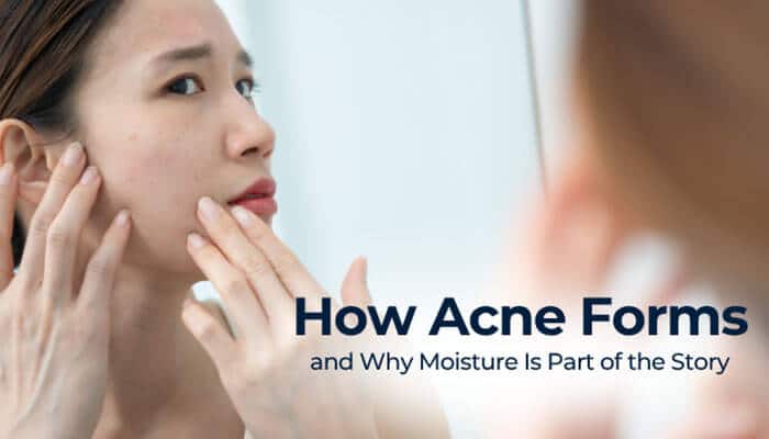 How Acne Forms and Why Moisture Is Part of the Story - Fashion In Beauty - Fashion in Beauty Does Hyaluronic Acid Help Acne? Realistic image of a woman examining acne-prone skin in the mirror, highlighting how dehydration, excess oil production, clogged pores, and weakened skin barriers contribute to acne formation and inflammation.