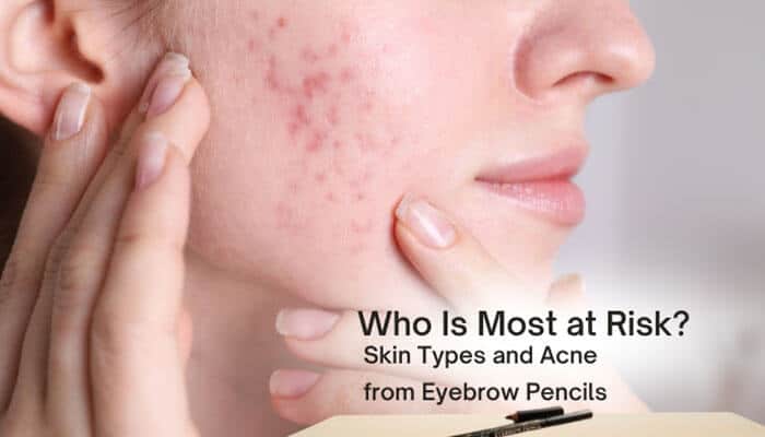 Who Is Most at Risk Skin Types and Acne from Eyebrow Pencils - Fashion In Beauty - Fashion in Beauty Can Zosisfod Eyebrow Pencil Cause Acne? Close-up of acne-prone skin showing inflamed breakouts and irritation, highlighting how oily, sensitive, and combination skin types may react to eyebrow pencil ingredients, clogged pores, bacteria buildup, and comedogenic cosmetic formulas.