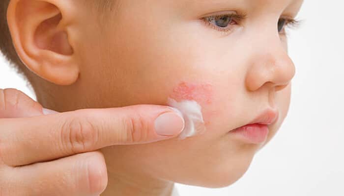 Baby Acne Treatment - Fashion in beauty - Fashion in Beauty Baby Acne vs Eczema treatment example showing a caregiver applying soothing cream to a child’s facial rash, highlighting gentle skincare and baby acne treatment methods for sensitive skin.