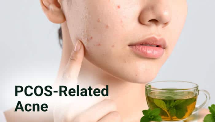 PCOS-Related Acne - Fashion In Beauty - Fashion in Beauty Spearmint Tea for Acne used as a natural support approach for PCOS-related acne, showing a close-up of facial breakouts commonly linked to hormonal imbalance and elevated androgens, alongside spearmint herbal tea known for its studied anti-androgenic properties that may help reduce acne severity over time.