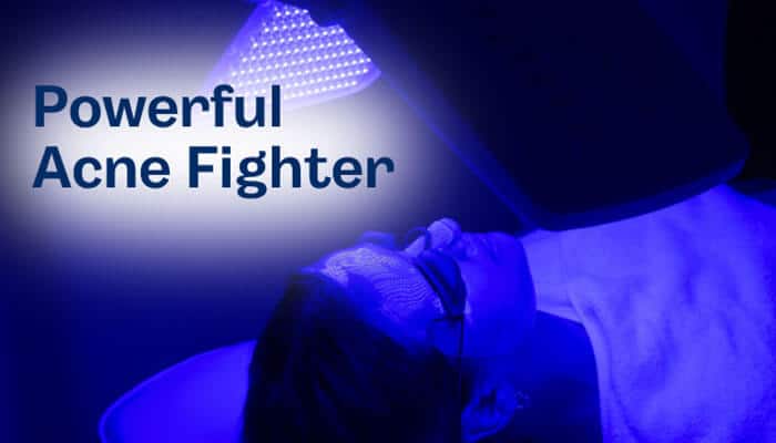 Powerful Acne Fighter - Fashion In Beauty - Fashion in Beauty Blue Light vs Red Light Therapy demonstrated with a blue light acne treatment, highlighting antibacterial action, inflammation reduction, and effective acne management