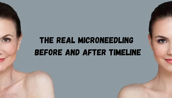 The Real Microneedling Before and After Timeline - Fashion in beauty - Fashion in Beauty Microneedling Before and After timeline showing facial skin improvement with smoother texture, reduced signs of aging, and a visibly more youthful complexion between pre-treatment and post-treatment results.