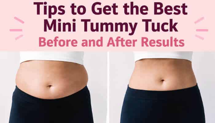 Tips to Get the Best Mini Tummy Tuck Before and After Results - Fashion In Beauty - Fashion in Beauty Mini Tummy Tuck Before and After showing tips for achieving the best results, highlighting improved lower abdominal contour, firmer skin, and natural post-surgery transformations.