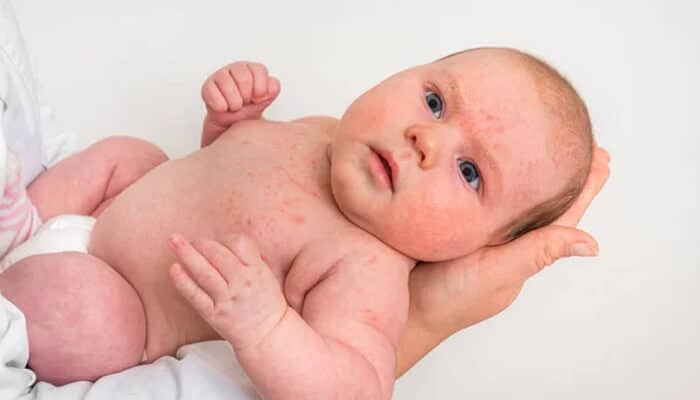 What Causes Baby Eczema - Fashion in beauty - Fashion in Beauty Baby Acne vs Eczema symptoms on infant skin, showing red facial and body rashes commonly seen in newborns, helping parents identify differences between baby acne and eczema.