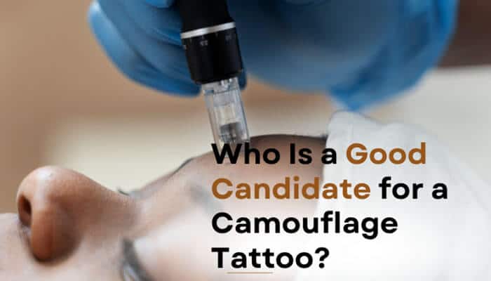 Who Is a Good Candidate for a Camouflage Tattoo - Fashion In Beauty - Fashion in Beauty Camouflage Tattoo for Hyperpigmentation procedure showing a trained practitioner using a precision microneedling tattoo device on skin to assess suitability for pigment-based skin tone correction in a clinical dermatology setting.
