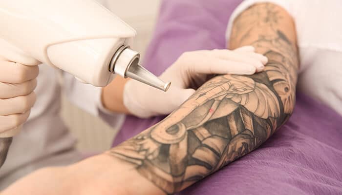 Why Professional Laser Removal Is the Gold Standard - Fashion in beauty - Fashion in Beauty Advanced laser tattoo removal treatment on a heavily tattooed arm, demonstrating why Tattoo Removal Creams cannot match the effectiveness of professional ink removal procedures.