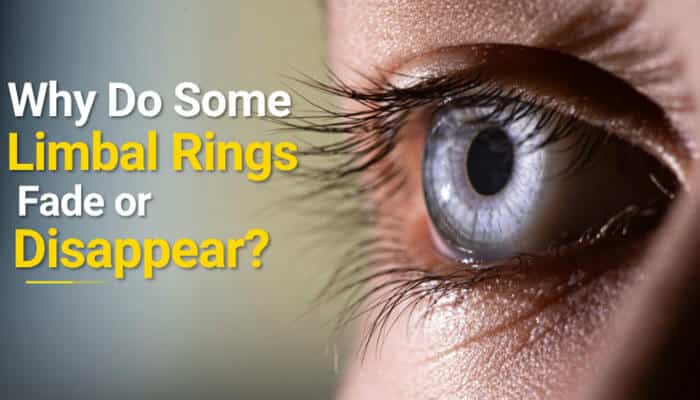 Why Do Some Limbal Rings Fade or Disappear - Fashion In Beauty - Fashion in Beauty Are Limbal Rings Rare? Close-up of a human eye with a faint limbal ring, illustrating how the dark border around the iris can naturally fade over time due to aging, genetics, corneal changes, eye pigmentation, and overall ocular health.