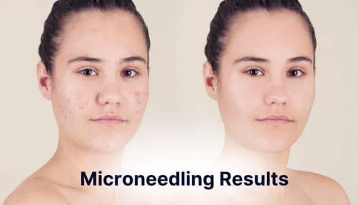 Microneedling Results - FAshion In Beauty - Fashion in Beauty Ultherapy vs Microneedling guide showing microneedling results with a before-and-after view of improved acne marks, skin texture, and complexion.