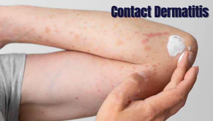 Contact Dermatitis - Fashion In Beauty - Fashion in Beauty What Is Triamcinolone Cream 0.1 Used to Treat showing topical triamcinolone cream applied for contact dermatitis relief, helping reduce skin inflammation, redness, itching, irritation, and allergic rash symptoms caused by dermatitis and eczema-related conditions.