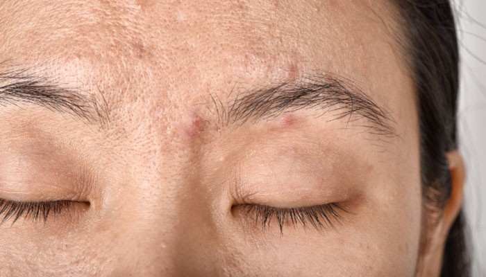 Could It Be Something Other Than Acne - Fashion In Beauty - Fashion in Beauty Acne Between Eyebrows showing small forehead and eyebrow-area bumps caused by common skin concerns such as clogged pores, excess oil production, dead skin cell buildup, and possible irritation from skincare or hair products.