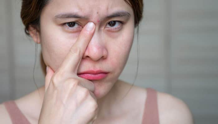 Does Acne Between Eyebrows Mean a Liver Problem - Fashion In Beauty - Fashion in Beauty Acne Between Eyebrows showing a person examining a facial breakout near the eyebrow area, highlighting possible clogged pores, excess oil buildup, skin irritation, and common causes of acne in the T-zone region.