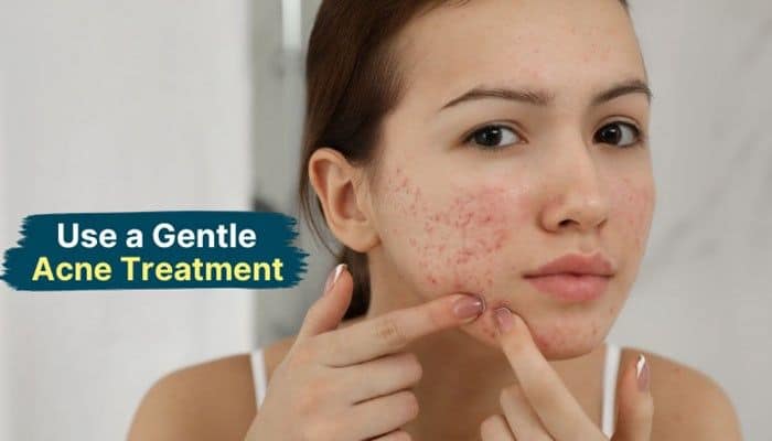 Use a Gentle Acne Treatment - Fashion In Beauty - Fashion in Beauty How to Get Rid of Pimple on Lip Fast using a gentle acne treatment routine, showing a woman applying skincare to acne-prone facial skin while highlighting safe remedies, clogged pore care, and dermatologist-recommended acne prevention methods