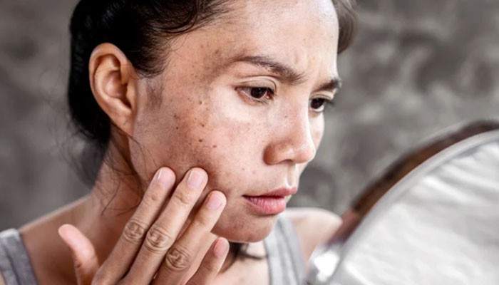 Are White Spots on Skin From Sun Dangerous - Fashion In Beauty - Fashion in Beauty Woman examining facial pigmentation in a mirror, highlighting concerns about White Spots on Skin From Sun and uneven skin tone.